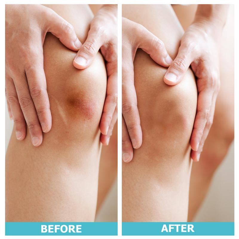 Medical grade hydrocolloid roll for - acne, bacne, ezcema and wounds