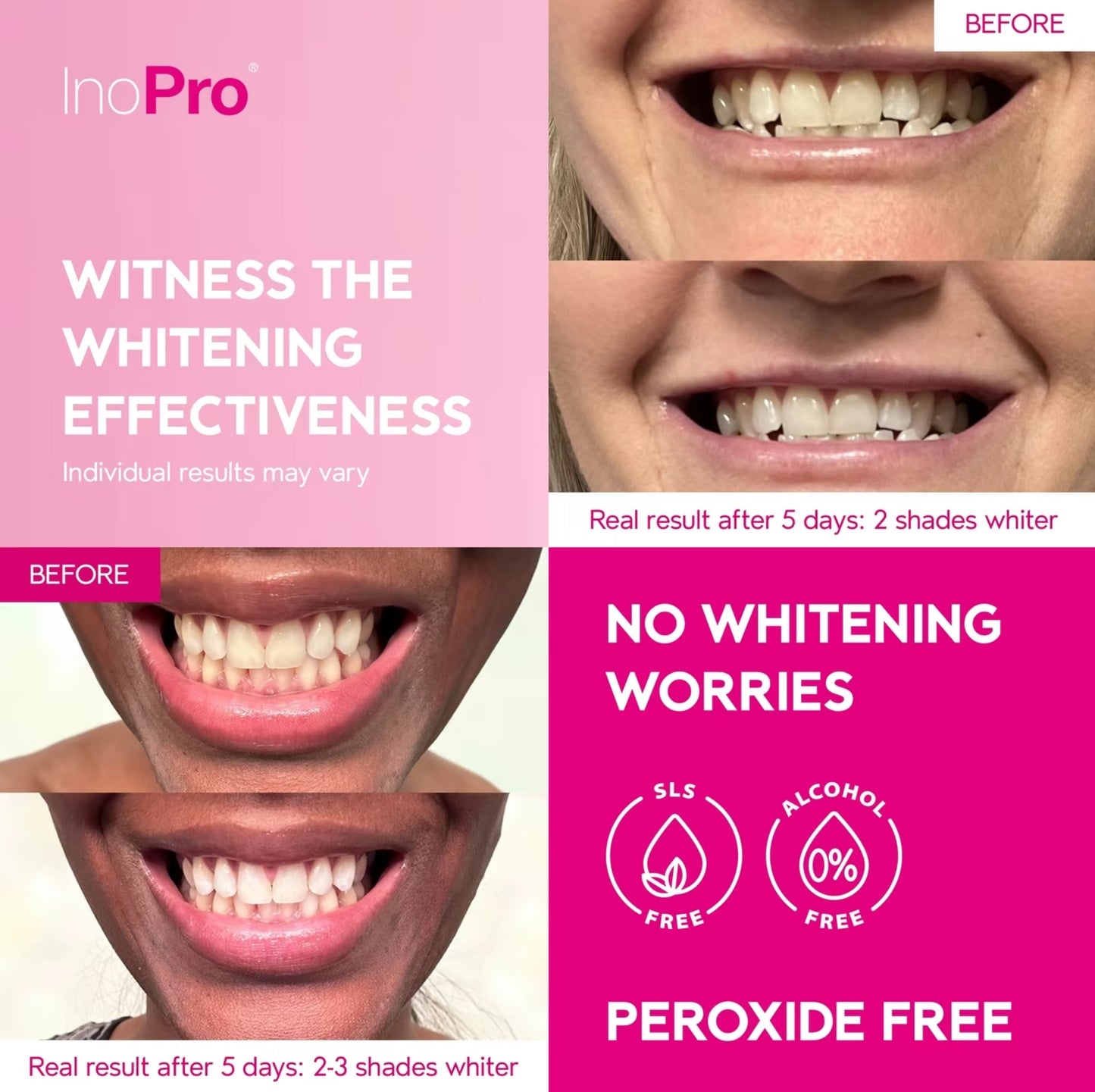 Soltera InPro Whitening Treatment